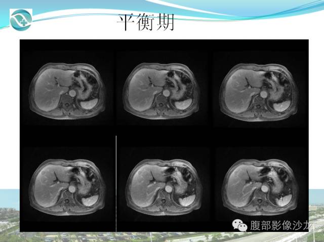 【病例】肝脏淋巴瘤1例CT及MR影像表现 【病例】肝脏淋巴瘤1例CT及MR影像表现