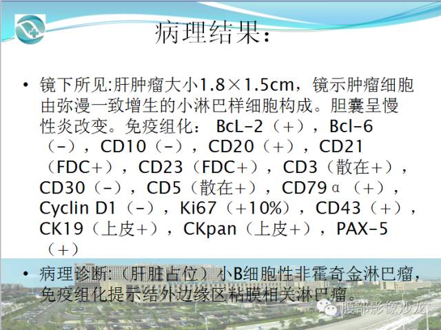 【病例】肝脏淋巴瘤1例CT及MR影像表现 【病例】肝脏淋巴瘤1例CT及MR影像表现