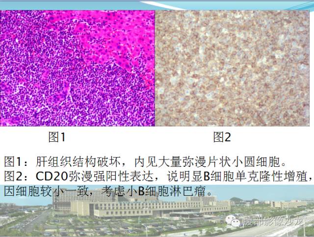 【病例】肝脏淋巴瘤1例CT及MR影像表现 【病例】肝脏淋巴瘤1例CT及MR影像表现