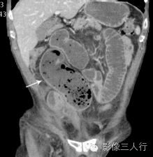 "小肠积粪征"，这个征象提示啥？