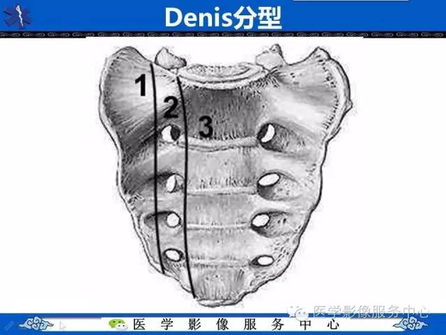 【影像征象】本田标志征