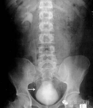 梨形膀胱（pear-shaped bladder）