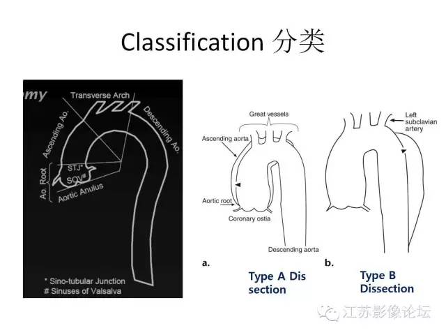 【PPT】急诊室经常遇到的急性主动脉疾病 【PPT】急诊室经常遇到的急性主动脉疾病