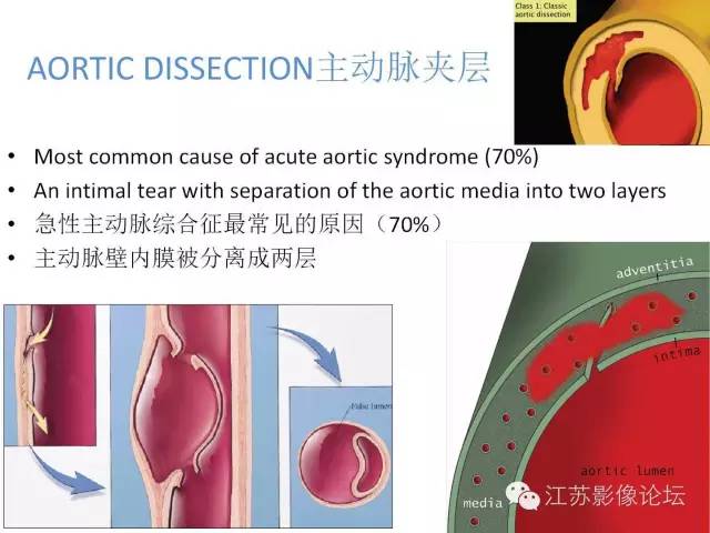 【PPT】急诊室经常遇到的急性主动脉疾病 【PPT】急诊室经常遇到的急性主动脉疾病