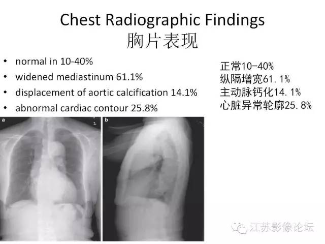 【PPT】急诊室经常遇到的急性主动脉疾病 【PPT】急诊室经常遇到的急性主动脉疾病
