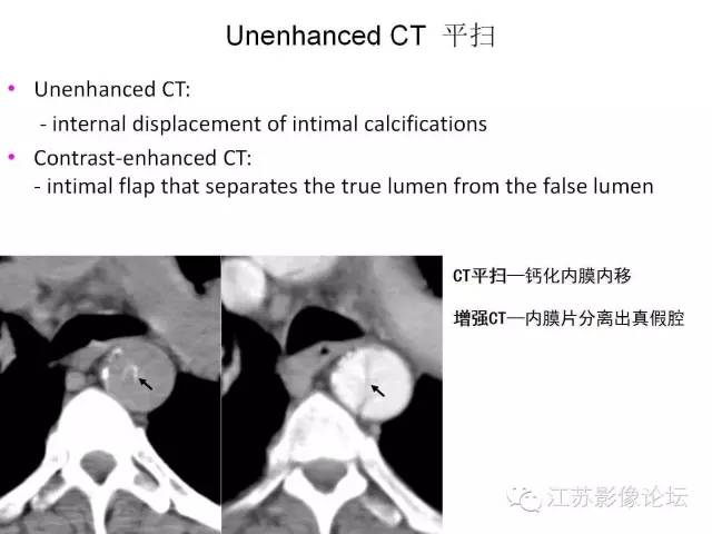 【PPT】急诊室经常遇到的急性主动脉疾病 【PPT】急诊室经常遇到的急性主动脉疾病