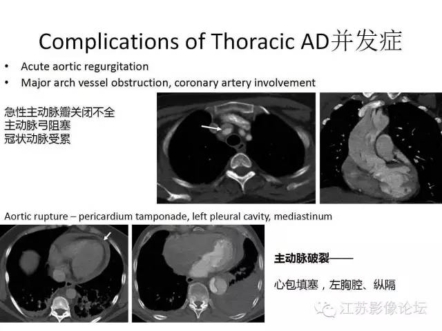 【PPT】急诊室经常遇到的急性主动脉疾病 【PPT】急诊室经常遇到的急性主动脉疾病