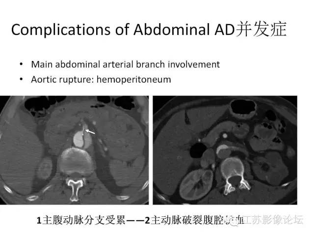 【PPT】急诊室经常遇到的急性主动脉疾病 【PPT】急诊室经常遇到的急性主动脉疾病