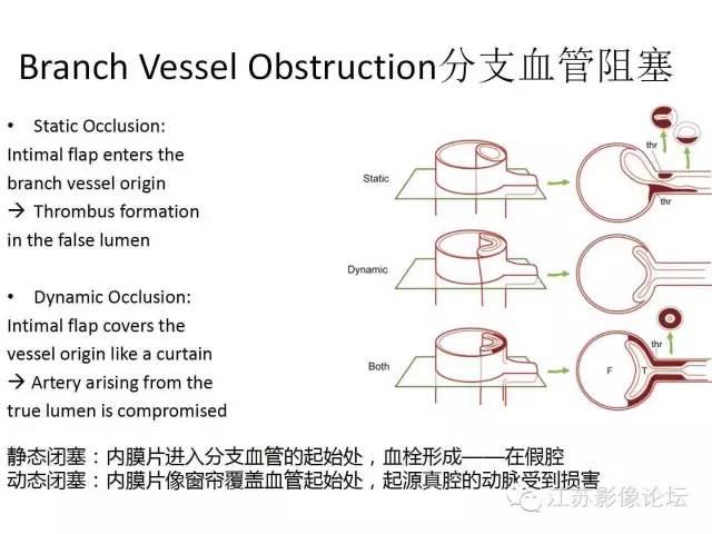 【PPT】急诊室经常遇到的急性主动脉疾病 【PPT】急诊室经常遇到的急性主动脉疾病