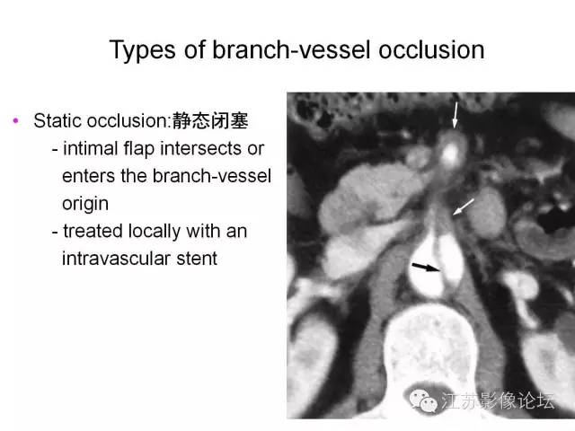 【PPT】急诊室经常遇到的急性主动脉疾病 【PPT】急诊室经常遇到的急性主动脉疾病