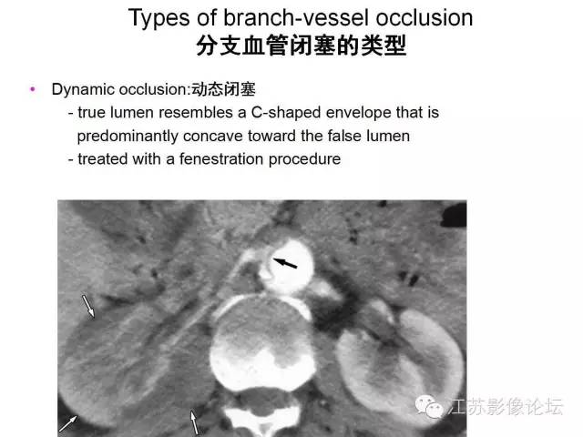 【PPT】急诊室经常遇到的急性主动脉疾病 【PPT】急诊室经常遇到的急性主动脉疾病