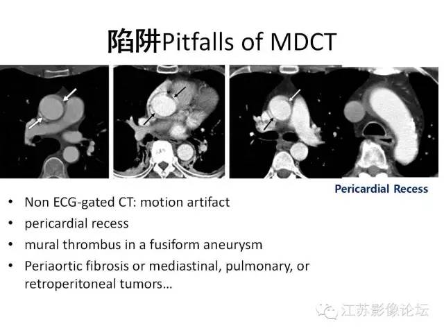 【PPT】急诊室经常遇到的急性主动脉疾病 【PPT】急诊室经常遇到的急性主动脉疾病