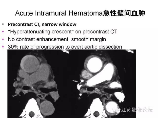 【PPT】急诊室经常遇到的急性主动脉疾病 【PPT】急诊室经常遇到的急性主动脉疾病