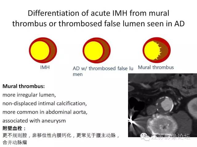【PPT】急诊室经常遇到的急性主动脉疾病 【PPT】急诊室经常遇到的急性主动脉疾病