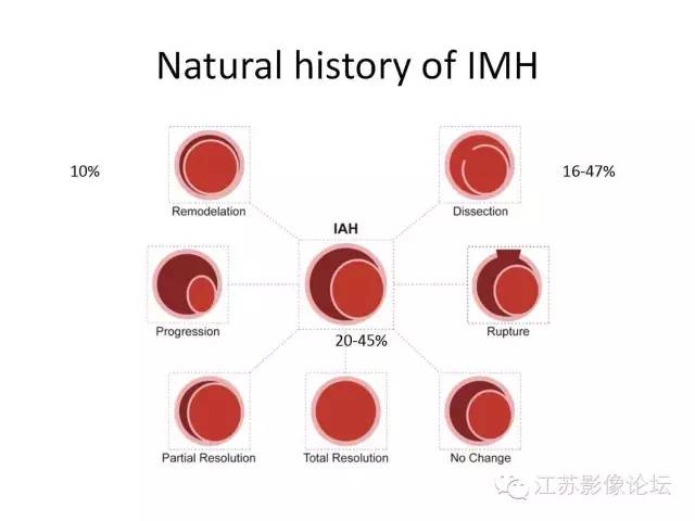 【PPT】急诊室经常遇到的急性主动脉疾病 【PPT】急诊室经常遇到的急性主动脉疾病