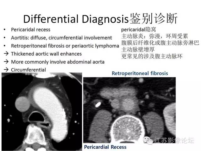 【PPT】急诊室经常遇到的急性主动脉疾病 【PPT】急诊室经常遇到的急性主动脉疾病
