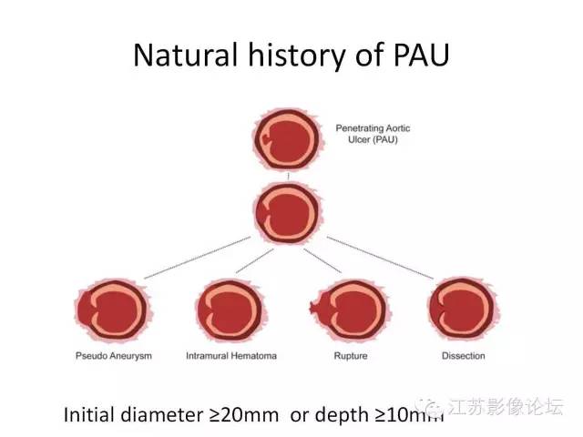 【PPT】急诊室经常遇到的急性主动脉疾病 【PPT】急诊室经常遇到的急性主动脉疾病