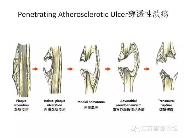【PPT】急诊室经常遇到的急性主动脉疾病 【PPT】急诊室经常遇到的急性主动脉疾病