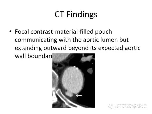 【PPT】急诊室经常遇到的急性主动脉疾病 【PPT】急诊室经常遇到的急性主动脉疾病