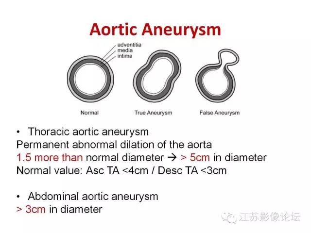 【PPT】急诊室经常遇到的急性主动脉疾病 【PPT】急诊室经常遇到的急性主动脉疾病