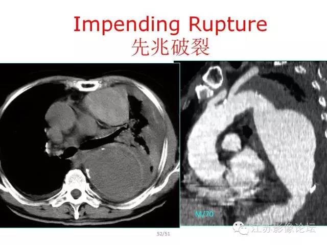【PPT】急诊室经常遇到的急性主动脉疾病 【PPT】急诊室经常遇到的急性主动脉疾病