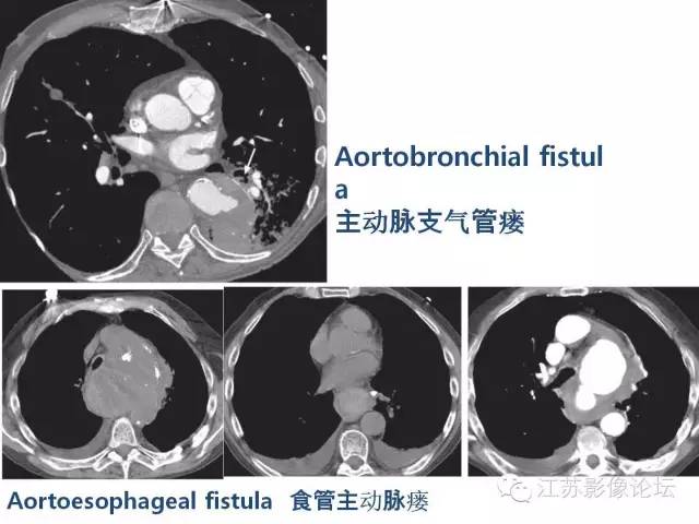 【PPT】急诊室经常遇到的急性主动脉疾病 【PPT】急诊室经常遇到的急性主动脉疾病