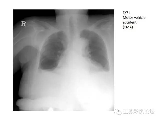 【PPT】急诊室经常遇到的急性主动脉疾病 【PPT】急诊室经常遇到的急性主动脉疾病