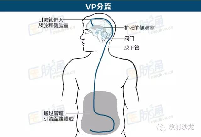 图文|你对中枢神经系统结核了解多少? 图文|你对中枢神经系统结核了解多少?