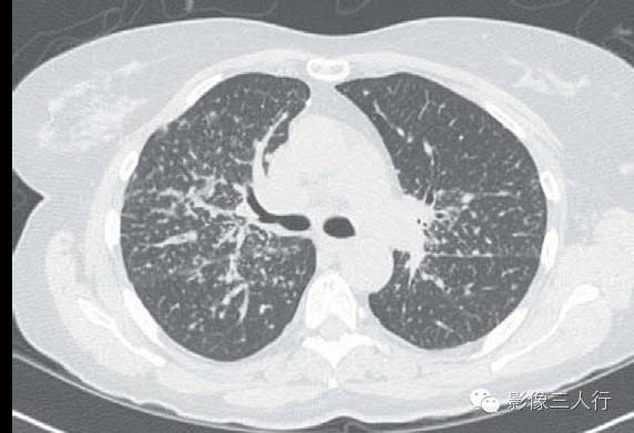 肺结节病（sarcoidosis）