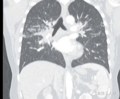 肺结节病(sarcoidosis) 肺结节病(sarcoidosis)