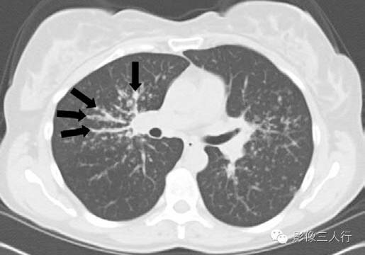 肺结节病(sarcoidosis) 肺结节病(sarcoidosis)