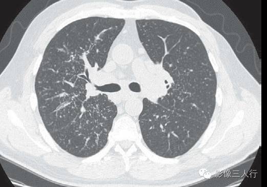 肺结节病(sarcoidosis) 肺结节病(sarcoidosis)