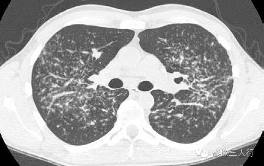 肺结节病(sarcoidosis) 肺结节病(sarcoidosis)