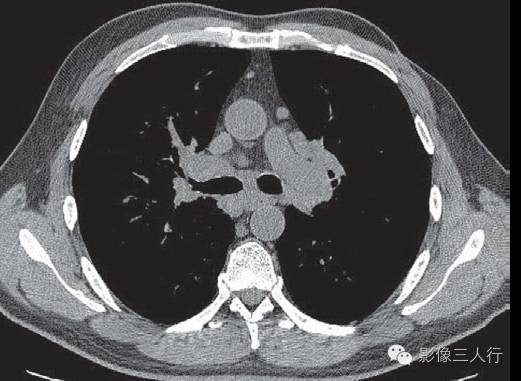 肺结节病(sarcoidosis) 肺结节病(sarcoidosis)
