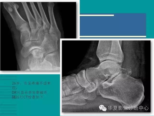 【病例】如此痛风，您认识吗？