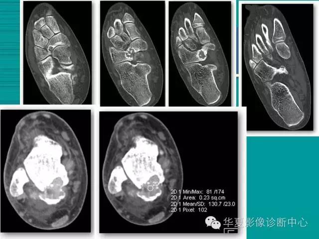【病例】如此痛风，您认识吗？