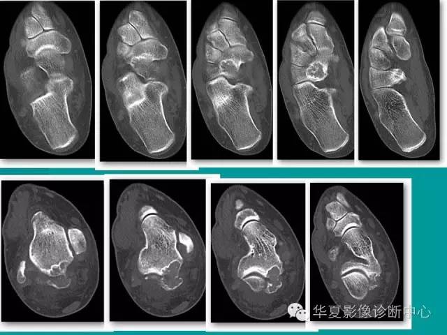 【病例】如此痛风，您认识吗？