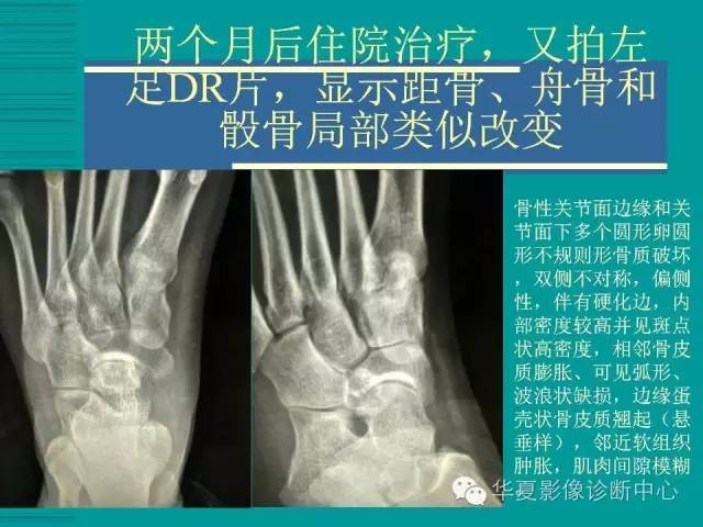【病例】如此痛风，您认识吗？