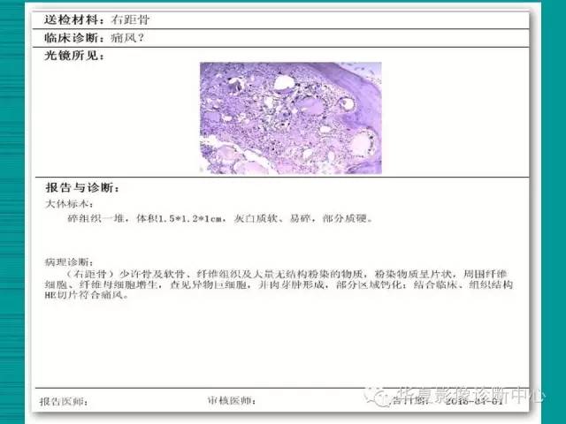 【病例】如此痛风，您认识吗？
