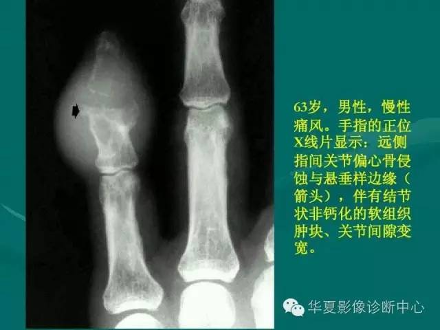 【病例】如此痛风，您认识吗？