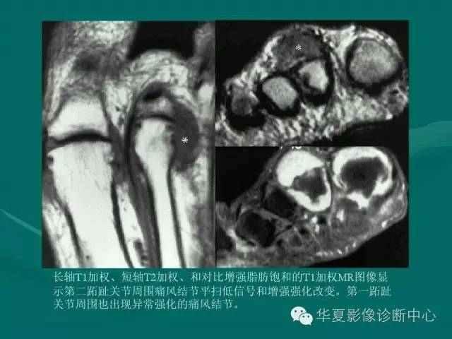 【病例】如此痛风，您认识吗？