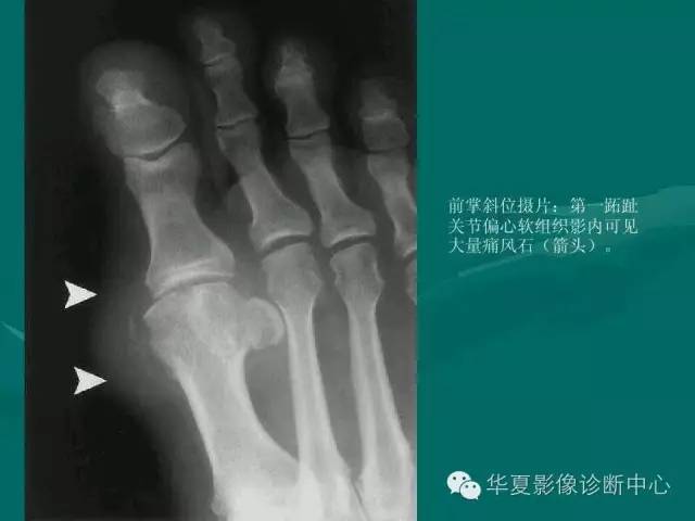 【病例】如此痛风，您认识吗？