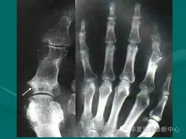 【病例】如此痛风，您认识吗？