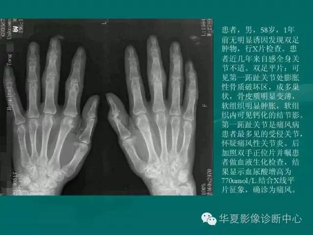 【病例】如此痛风，您认识吗？