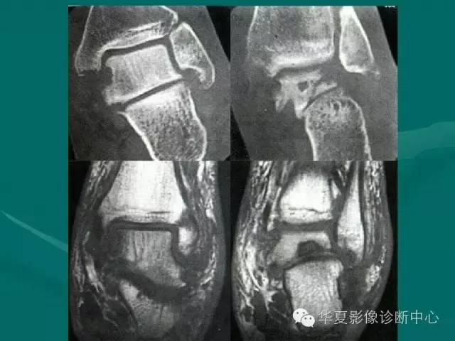 【病例】如此痛风，您认识吗？