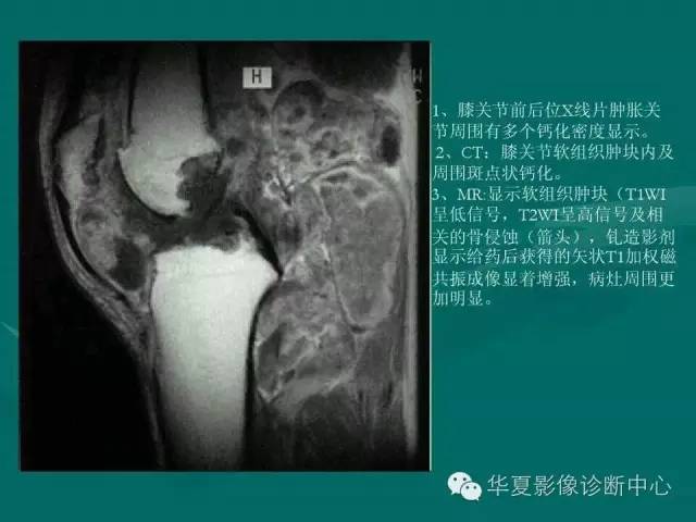 【病例】如此痛风，您认识吗？