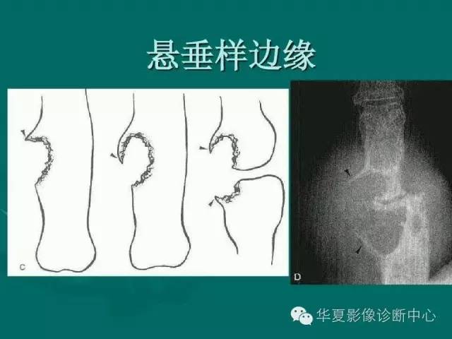 【病例】如此痛风，您认识吗？