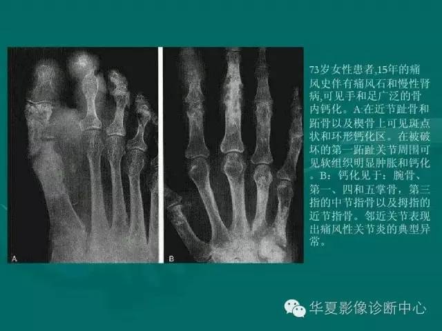 【病例】如此痛风，您认识吗？