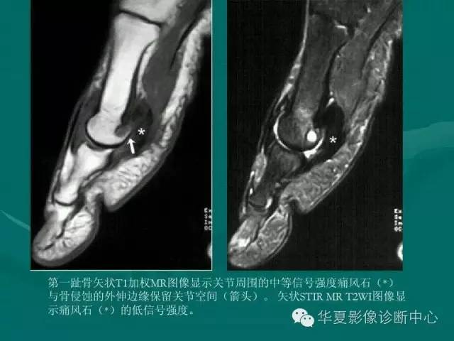 【病例】如此痛风，您认识吗？