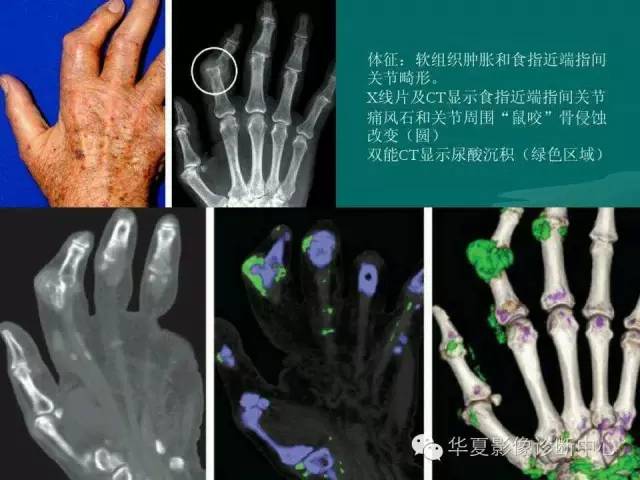 【病例】如此痛风，您认识吗？